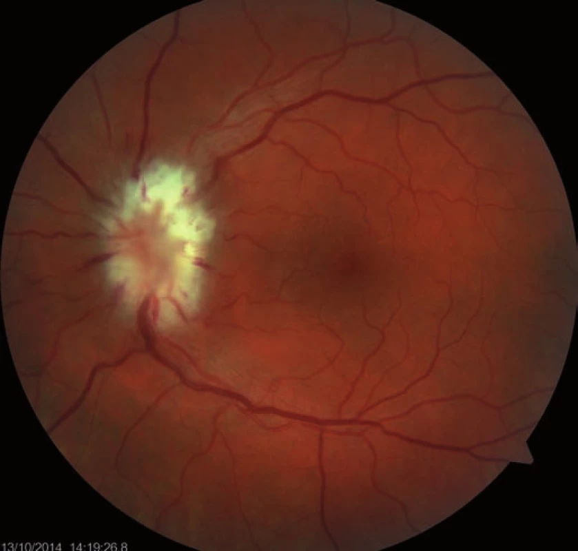 Ischemic edema of the whole optic nerve disc (after seven days).