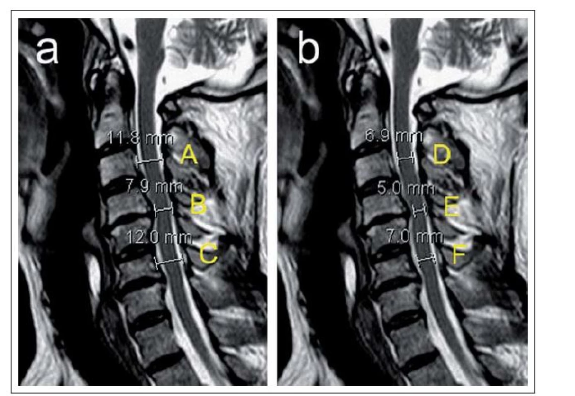 a,b) Ukázka různých měření popisujících míru stenózy páteřního kanálu a míšní komprese u pacienta se sekundární spinální stenózou s maximem v etáži C4/5 znázorněné na sagitálních T2 vážených skenech MR zobrazení (a,b).