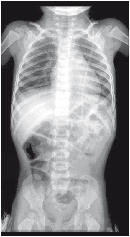 RTG vyšetření břicha s nálezem nedostatečné délky peritoneálního katétru.