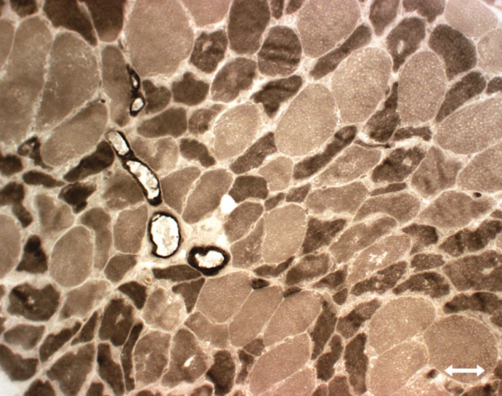 Atrofie vláken typu II (myosinová ATP-áza, tmavá vlákna typu 2, světlá vlákna typu 1).