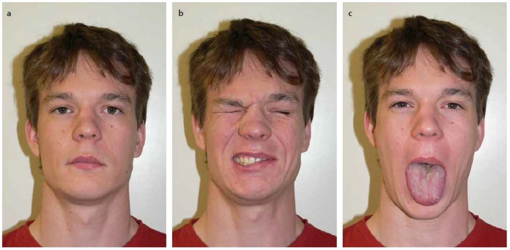 Pacient 4,5 roku po hemihypoglossofaciální anastomóze vlevo.
