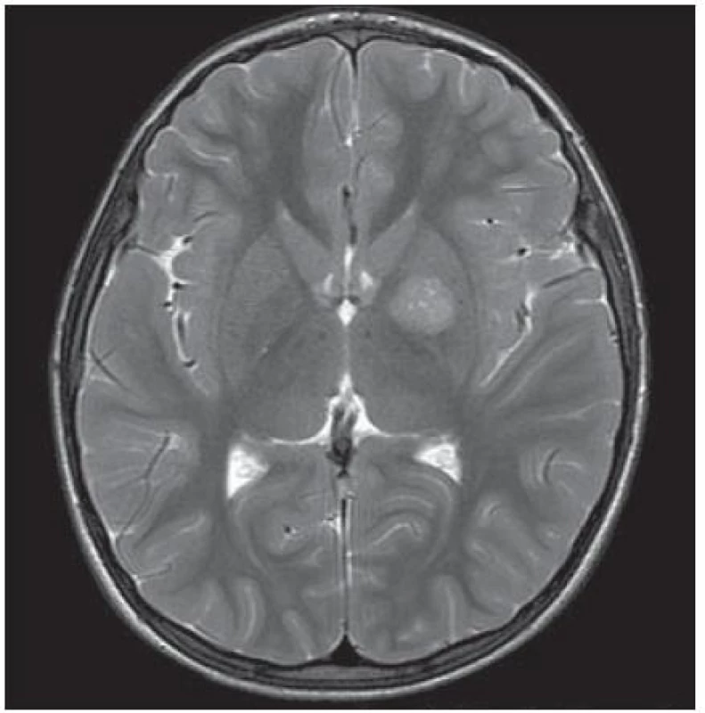 MR mozku, T2 zobrazení, transverzální řez: patologické ložisko zvýšeného T2 signálu velikosti 16 × 16 × 17 mm v levém globus pallidus.