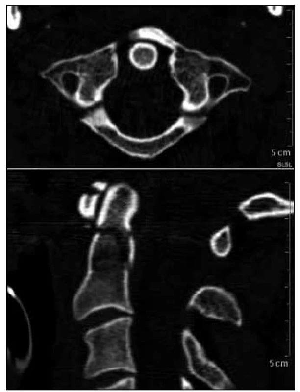 CT obraz tříúlomkové zlomeniny C1 Jeffersonova typu a zlomeniny dentu C2 d’Alonzo II při příjmovém vyšetření.