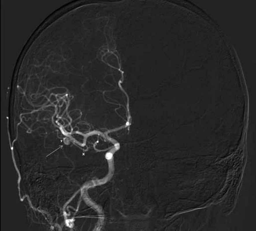 AP projekce angiografie prokazuje lokalizaci aneuryzmatu (→) mimo vlastní větvení M2/3 na arteria temporalis anterior (ATA).
x – přívodná část tepny, y – odvodná část ATA.