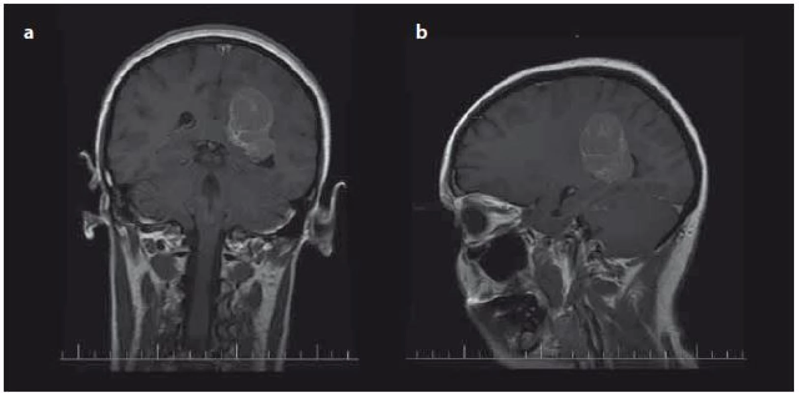 Typická lokalizace intraventrikulárních meningiomů v oblasti trigona postranních komor – předoperační MR s kontrastní látkou u pacienta s meningiomem trigona levé postranní komory koronální (a), sagitální (b).
Fig. 1. Typical localisation of intraventricular meningiomas in trigonal area of lateral ventricles – preoperative contrast enhanced T1-weighed image of patient with meningioma of left trigonal area (a) coronal plane, (b) sagital plane.