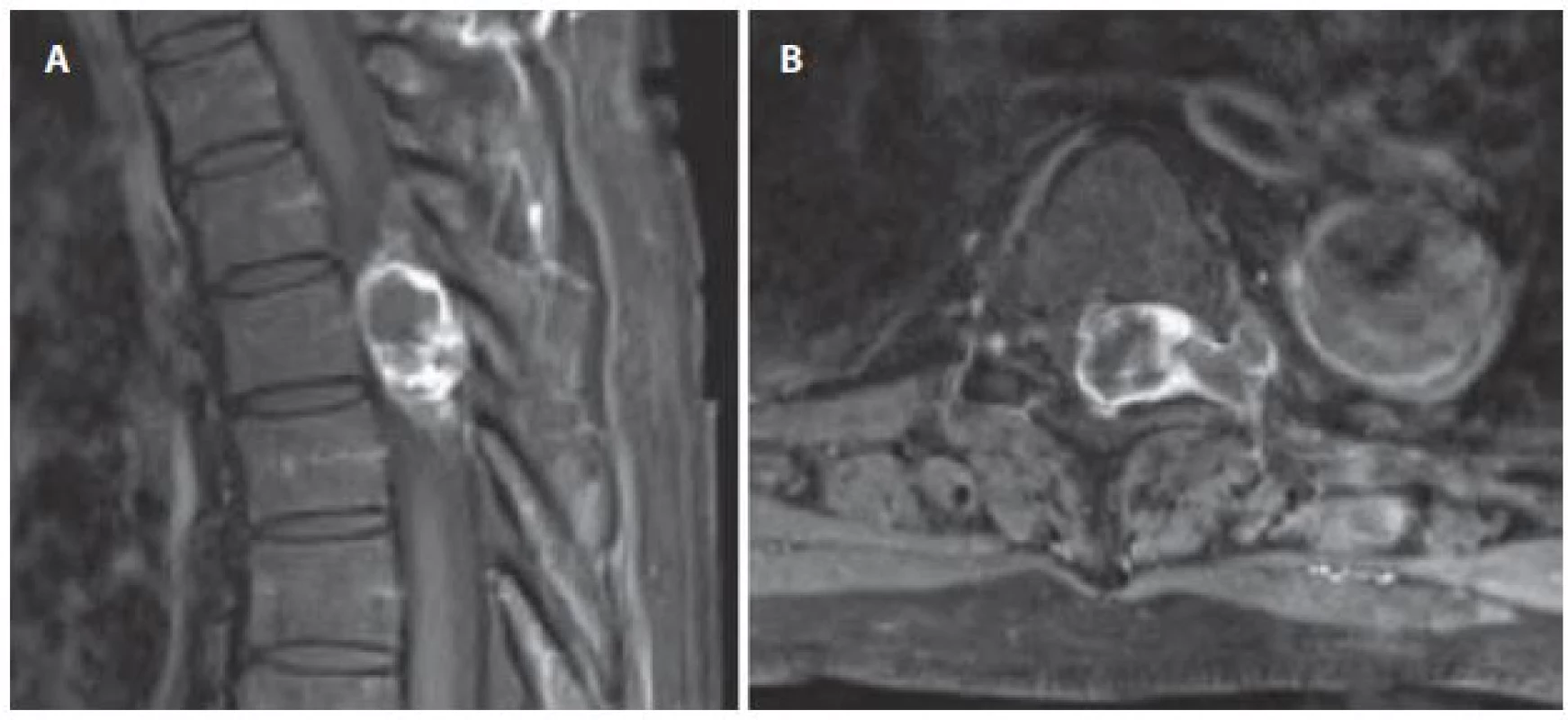 Sutkovitý neurinom v Th5–Th6 vlevo, intraspinální porce je extradurálně.
Obr. 8a) MR v sagitální rovině.
Obr. 8b) MR v axiální rovině.
Fig. 8. Dumbbell-shaped left sided neurinoma at level Th5–Th6, intraspinal part is extraduraly.
Fig. 8a) Sagittal view MRI.
Fig. 8b) Axial view MRI.