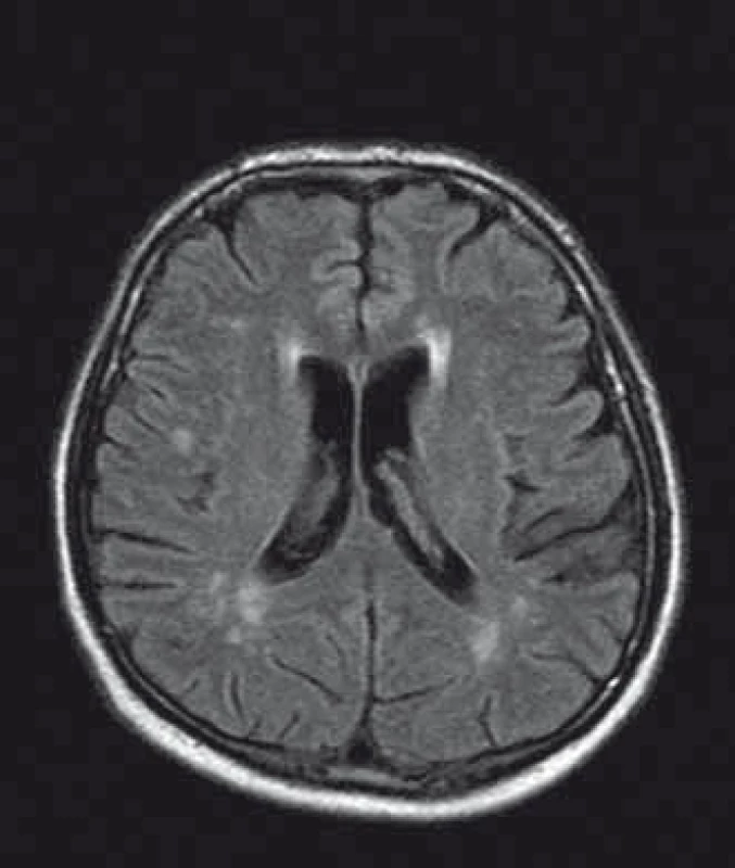 MR mozku, axiální řez, FLAIR, pacient s Fabryho chorobou, postižení bílé hmoty.
Fig. 2. Brain MRI, axial plane, FLAIR, Fabry disease patient, white matter lesions.