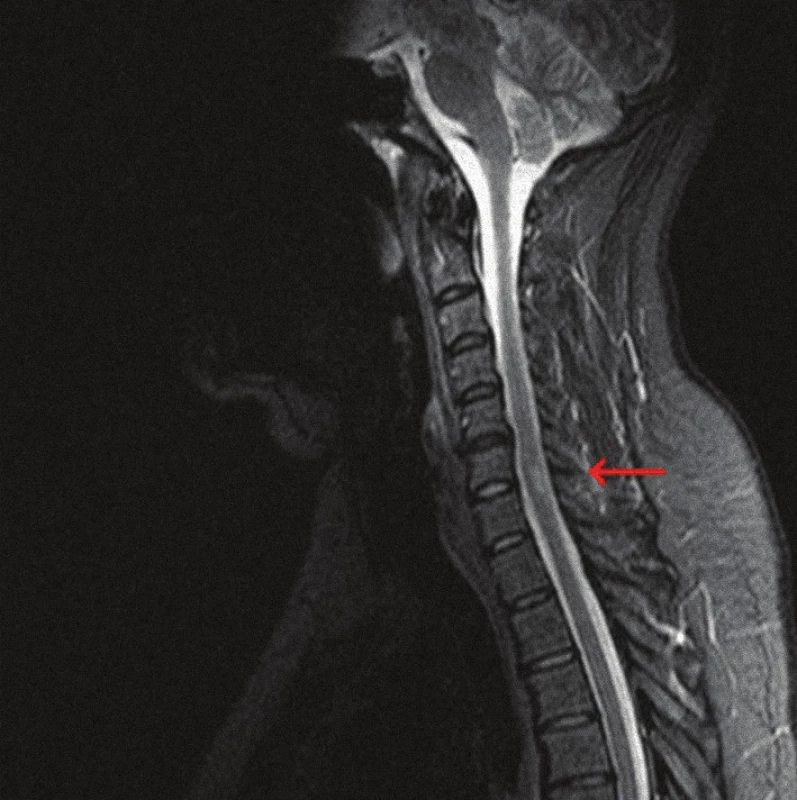 MRI krčnej miechy (STIR, sagitálny rez) s regresiou ložiska. po pulznej vnútrožilovej liečbe metylprednizolonom.