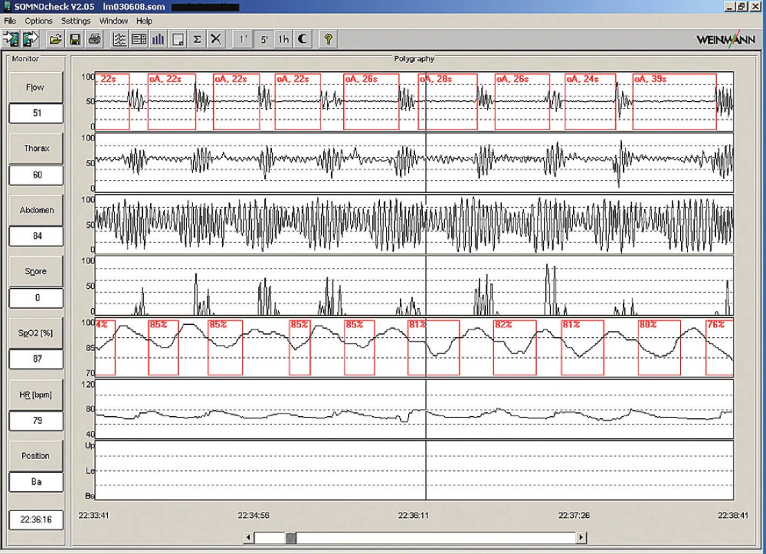 Ukázka 5minutové polygrafie s typickými obstrukčními apnoemi.
Pacient 57letý muž, BMI 40,6; hypertenze; AHI 89.