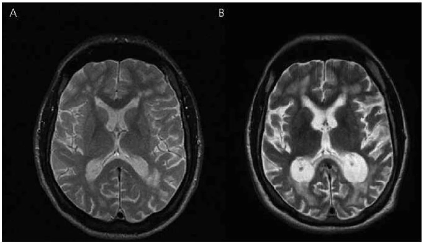 Magnetická rezonance mozku pacienta IV-7.
Transverzální řezy v T2 vážených obrazech – vývoj atrofie: (A) rok 2003, (B) rok 2010.