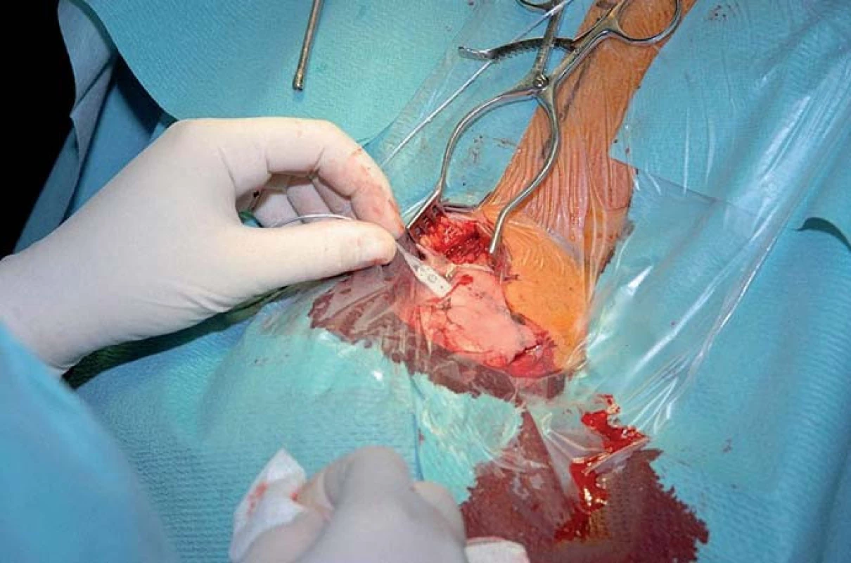 Chirurgická technika zavedení ploché elektrody k okcipitálnímu nervu.