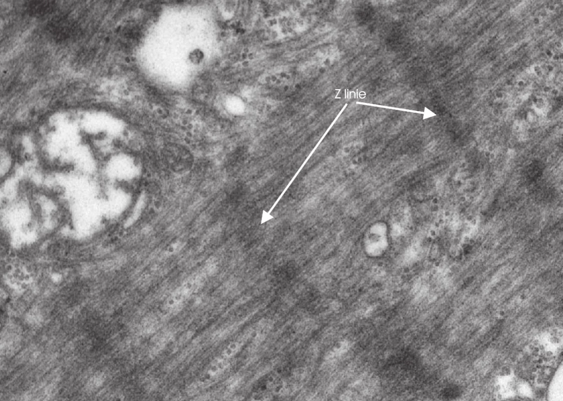 Elektronmikroskopický obraz myopatie se ztrátou silných myosinových filament, jsou patrny pouze zachované Z linie.