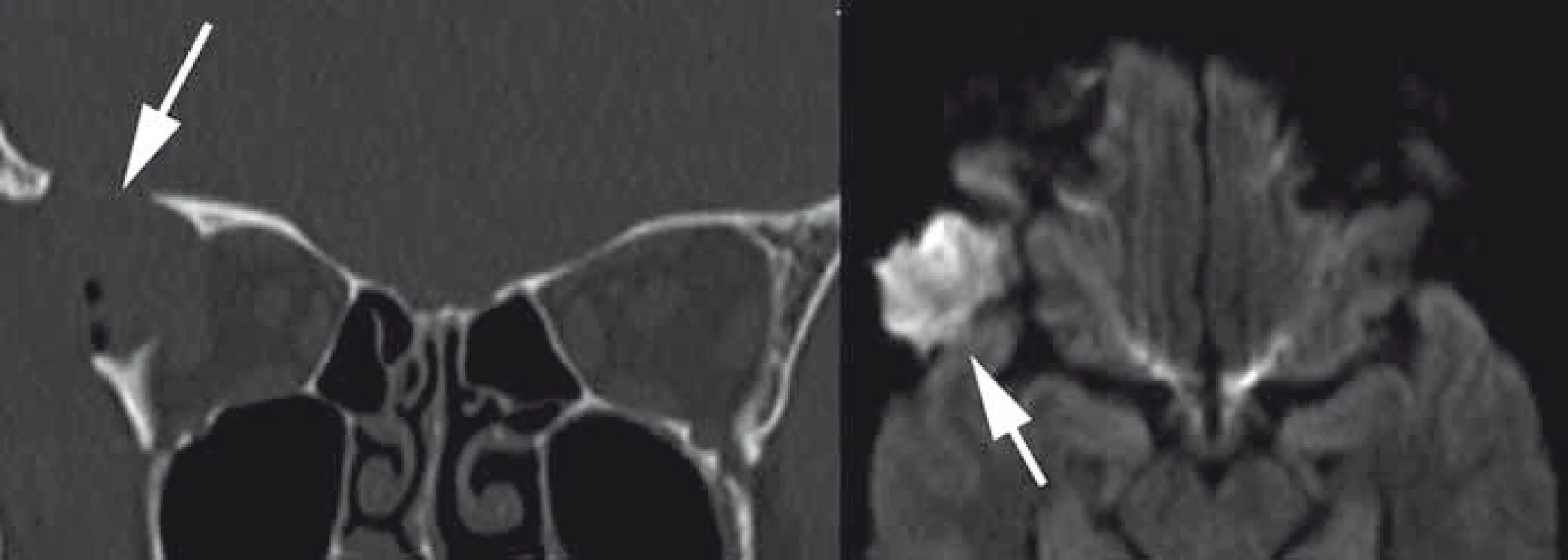 Dermoid frontozygomatické sutury vpravo v CT (vlevo) a DW MR obraze (vpravo).