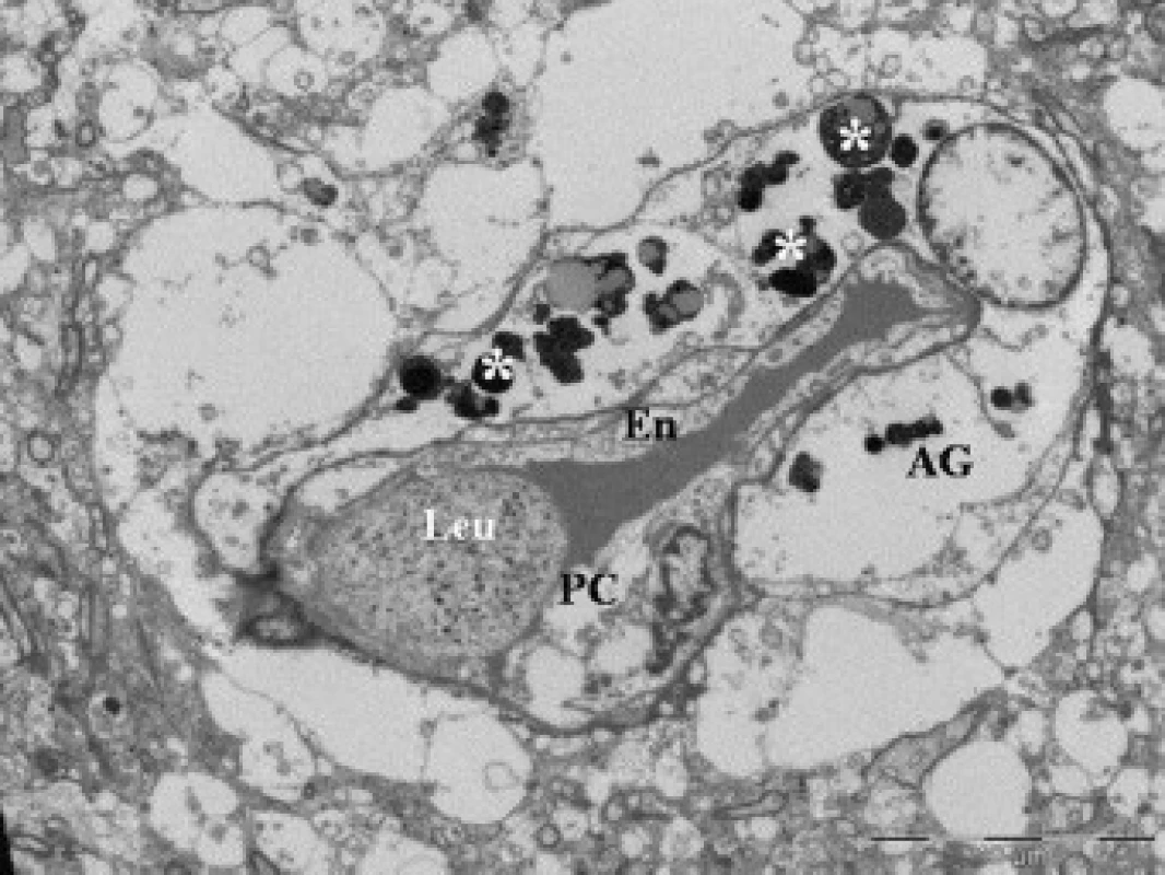 Elektronová mikroskopie kontuzního ložiska u pacienta (soubor II), zobrazení lumen kapiláry s leukocytem (Leu). Na řezu zachycen cytotoxický edém endotelie (En), pericytu (PC) a astrogli (AG); formování telolyzozomů (*).