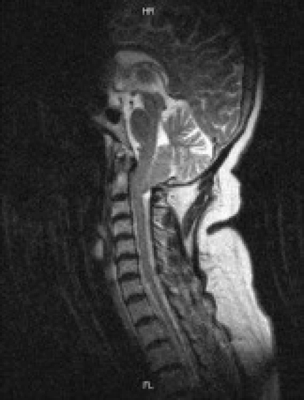 MRI vyšetření 52leté ženy s Chiariho malformací typu I B.