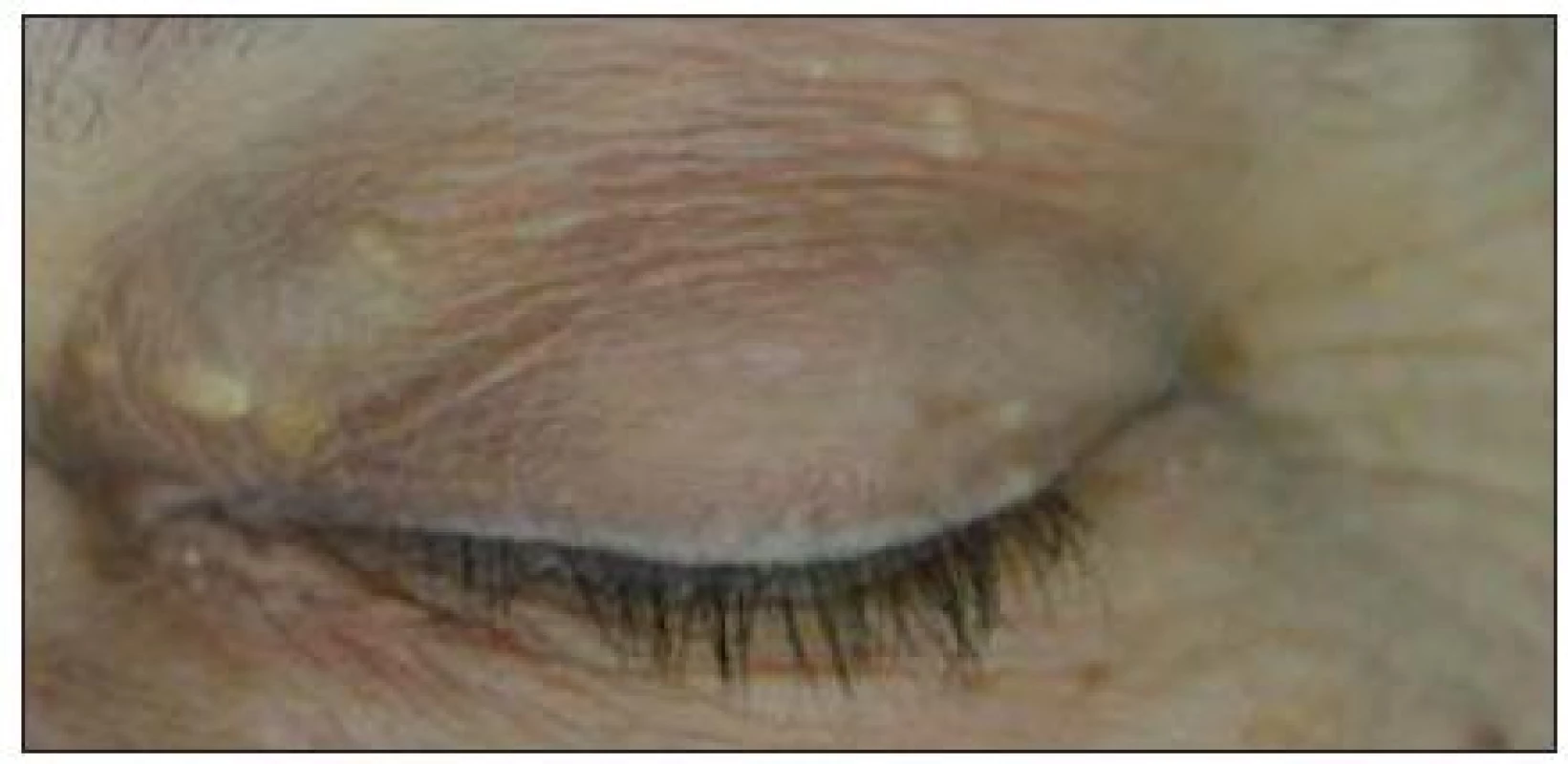 Patrná dilatace VOS ve vnitřním koutku levého oka.