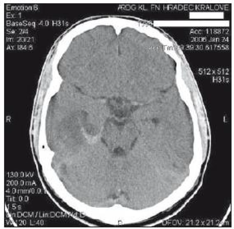 CT mozku z 24. ledna: encefalitické ložisko vpravo temporálně vel. 3 × 4,5 cm s drobnou hemoragickou složkou, mírný přetlak středočárových struktur doleva.
