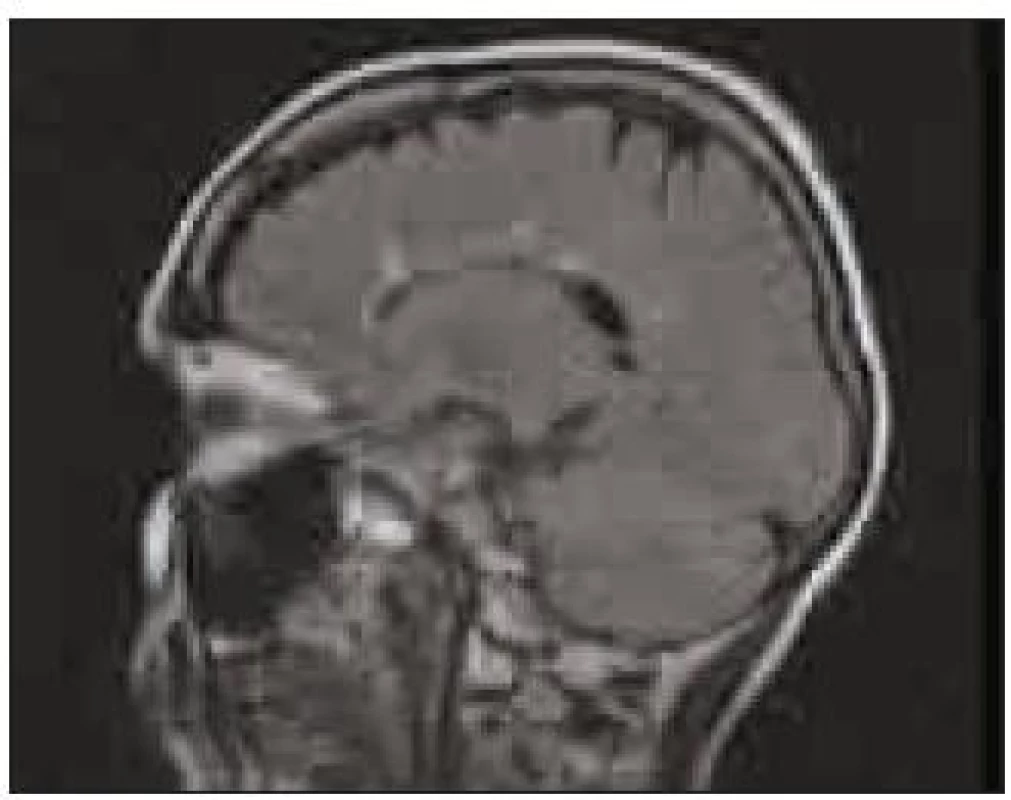 Doplněné vyšetření MR mozku potvrzující další ložiska v bílé hmotě mozkové.