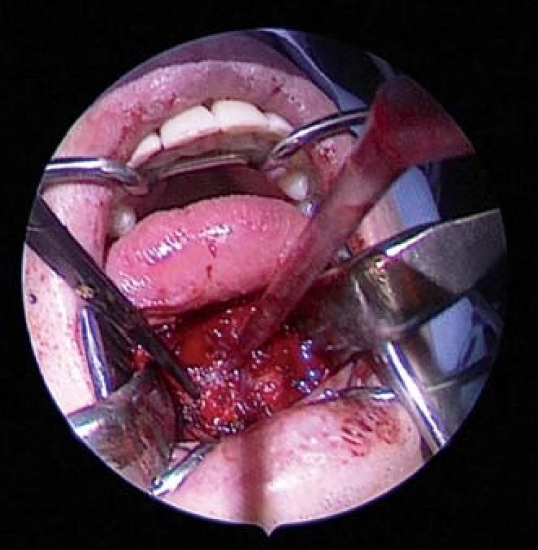 Intraorální exstirpace rezistence spodiny dutiny ústní.