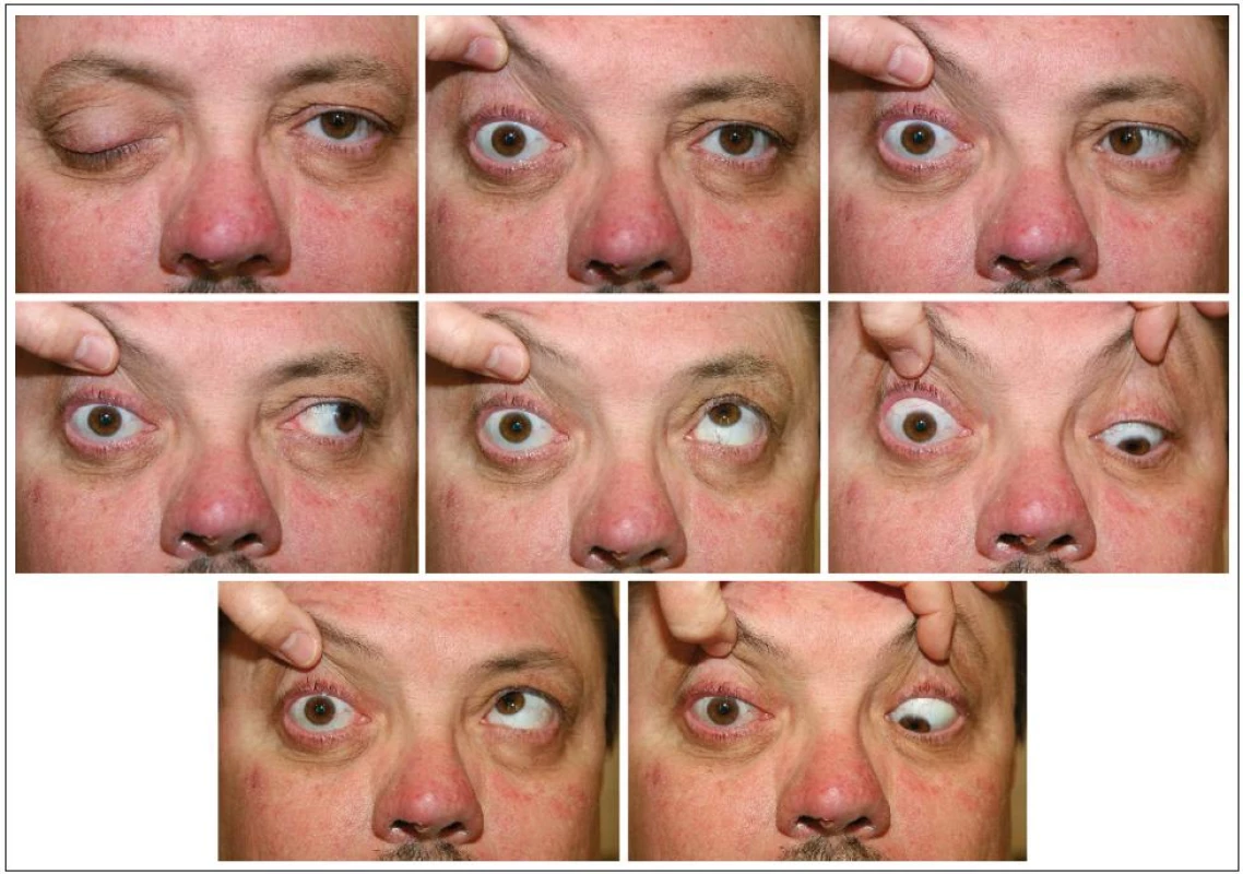 Obraz totální oftalmoplegie a lehké protruze vpravo jeden týden po resekci tumoru.
