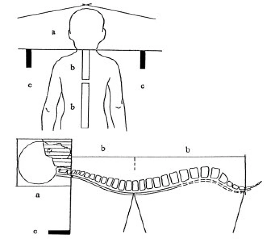 Schéma techniky radioterapie kraniospinální osy v supinační poloze za využití asymetrických clon; a – dvě laterolaterální pole na oblast mozkovny a krční míchy, b – spinální přímá pole, c – uzavření kolimátorového systému asymetrickými clonami do roviny centrálního paprsku („brněnská technika“).