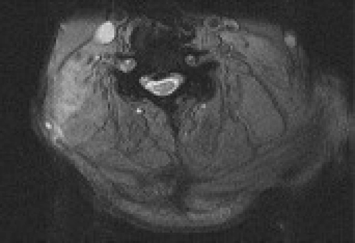 MRI krční páteře s nálezem subluxace, která svědčí pro přítomnost instability mezi kostními bloky C1–4 a C5–Th1. V oblasti krční míchy je patrné hyperintenzní ložisko signálu na T2 vážených snímcích charakteru cervikální myelopatie (pacient č. 4). Sagitální (A) a axiální (B) snímek.