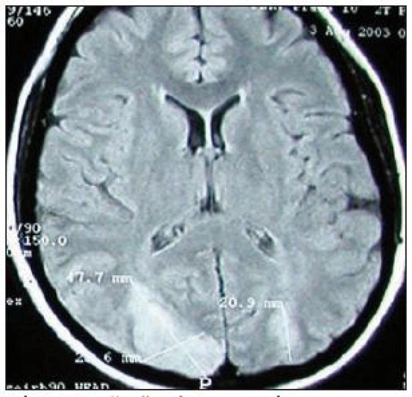 Vyšetření MR mozku, FLAIR. Akutní ischemické ikty v polech obou okcipitálních laloků, vzniklých jako následek RCVS, odpovídající obrazu PRES.