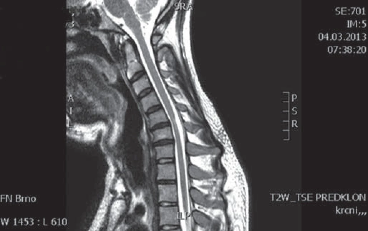 Pacient 1 – MR C páteře ve flexi, T2 vážené obrazy, sagitální řez.
