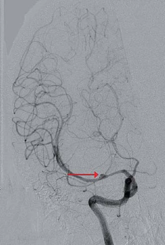 Digitální subtrakční angiografie mozku, koronární projekce, široké kopulovité rozšíření středního úseku ACM M1 vpravo s plnícím se drobným sekundárním vakem na jejím hrotu (červená šipka), nelze vyloučit objemnější trombozované aneuryzma s krčkem odstupujícím proximálně.