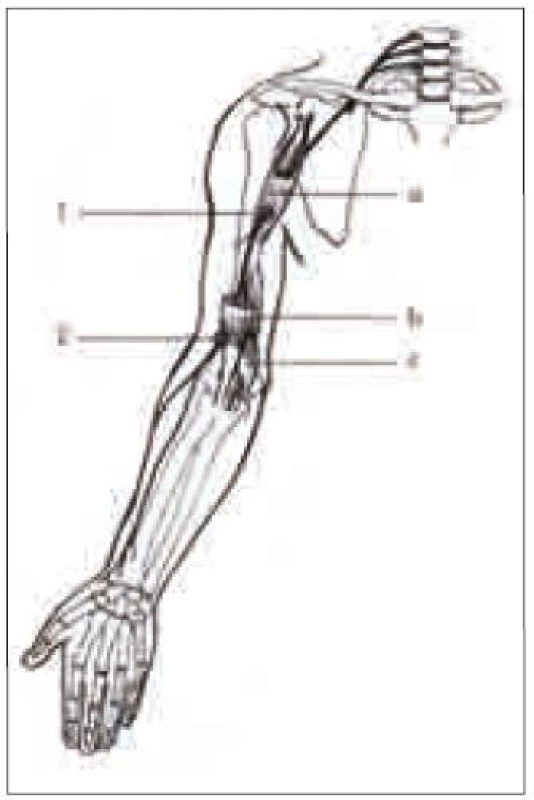 Schéma n. musculocutaneus.
Úžiny: 1. průchod přes m. coracobrachialis; 2. průchod n. cutaneus antebrachii lateralis fascií. Svaly: a) m. coracobrachialis; b) m. biceps brachii; c) m. brachialis.