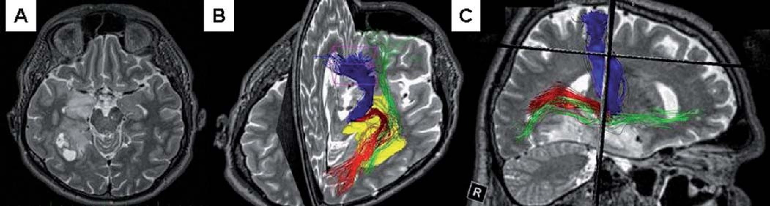 Předoperační grafické zobrazení.
Obr. 2a) MR T2W – gliom celé délky mediobazálního temporálního komplexu vpravo, zadní část ohraničená cystami.
Obr. 2b) Předoperační traktografie; modře – pyramidová dráha, červeně – optická radiace, zeleně – fasciculus occipito-frontalis, žlutý – tumor.
Obr. 2c) Sagitální pohled na vztah tumoru k výše uvedeným drahám.