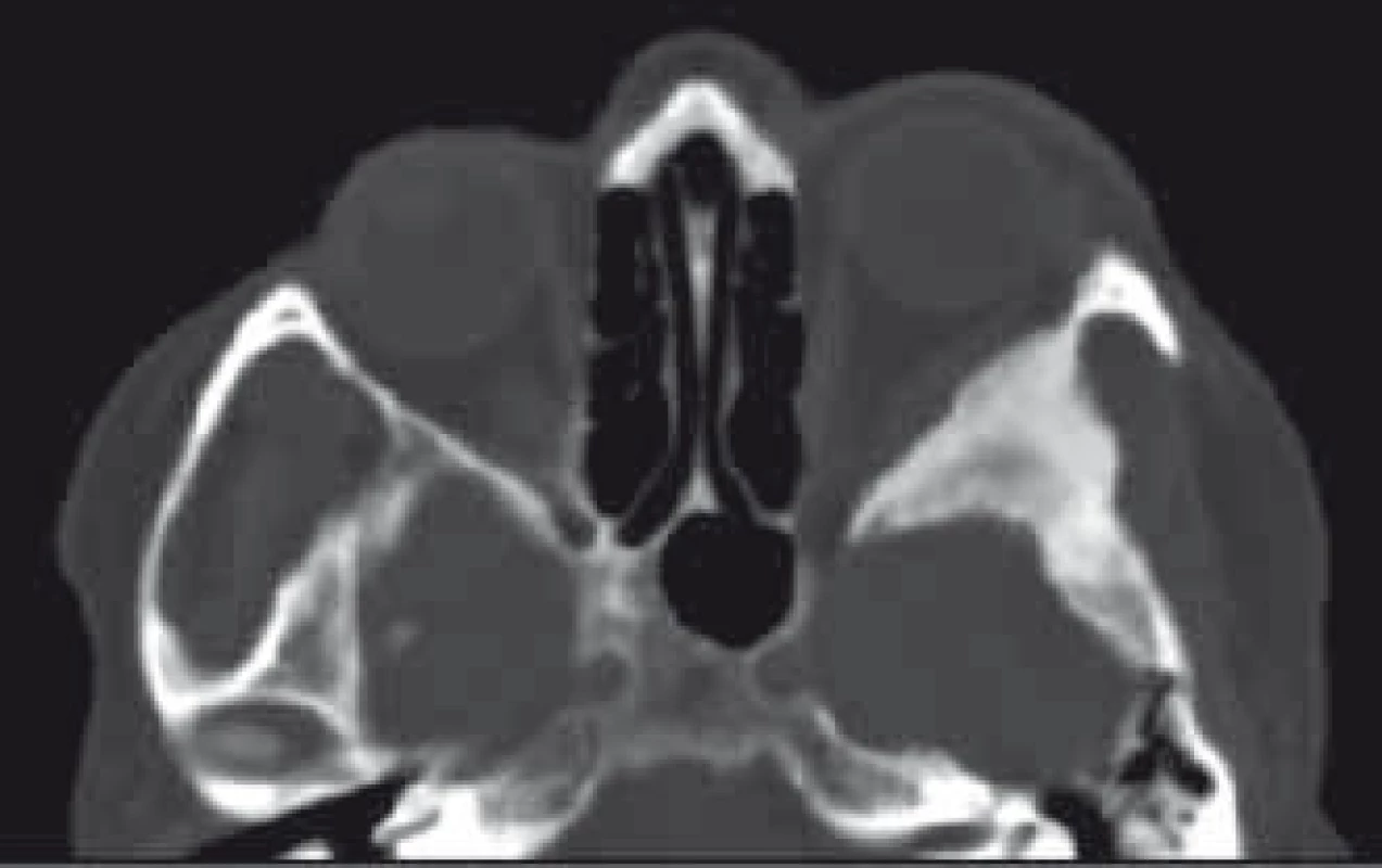 CT obraz fibrózní dysplazie křídla vlevo s charakteristickým vzhledem mléčného skla 
a chybějící měkkotkáňovou složkou typickou pro meningeom.
