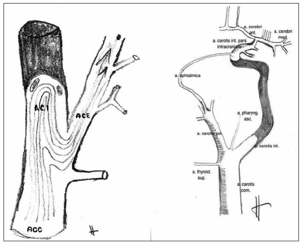 Schematické znázornění cesty embolizace z pahýlu okludované vnitřní krkavice do zevní krkavice.