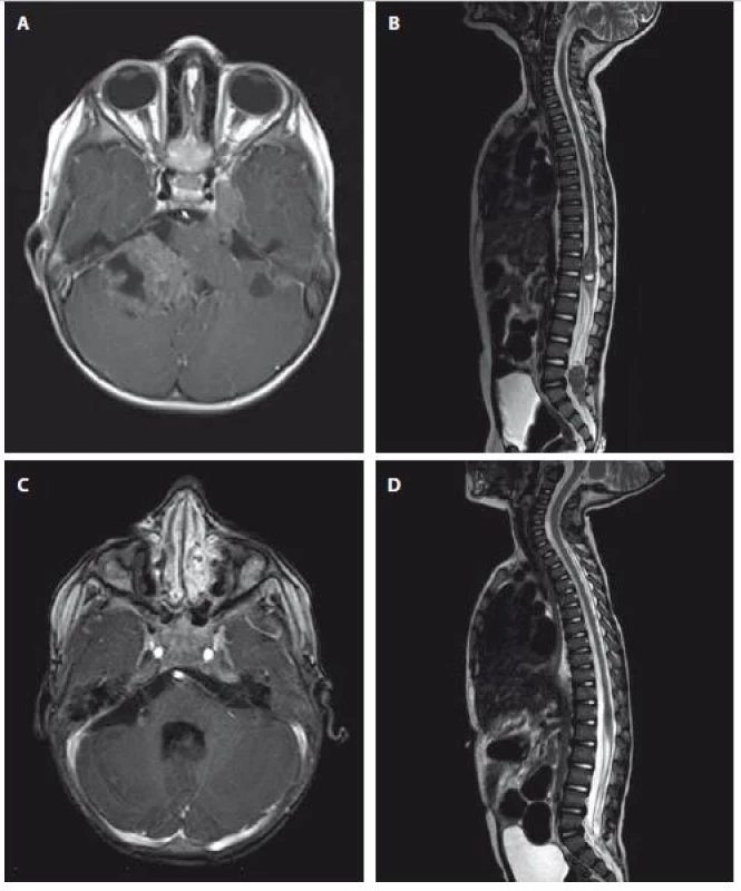 A–D. Magnetická rezonance. Axiální T1 vážený postkontrastní obraz ukazující nehomogenně
sytící se ložisko v zadní jámě lební vpravo, které zasahuje do foramen magnum, infiltruje pravou cerebelární hemisféru a mozkový kmen (obr. A). Dále jsou na axiálním zobrazení patrné menší útvary – metastázy podobného vzhledu v zadní jámě lební vlevo, v oblasti Gasserského ganglia vlevo a v pravém hippokampu. T2 vážený obraz páteřního kanálu odhalující 2 metastatická ložiska Th11–L1 a L4–S2 (obr. B).
Obr. 2C a 2D zobrazuje kontrolní MR mozku a cerebrospinální osy, 7 měsíců od primární resekce je patrná jasná regrese primárního ložiska vč. všech metastatickým lézí.
Fig. 2A–2D Magnetic resonance. T1-weighted images showing heterogenously enhancing tumor of posterior skull fossa reaching foramen magnum and infiltrating right cerebellar hemisphere and brain stem (A). Furthermore, other foci of metastasis in left posterior skull fossa, in ganglion Gasseri regionand in right hippocampus are visible. T2-weighted image of spinal cord showing 2 metastatic foci Th11–L1 and L4–S2 (B).
Fig. 2C and 2D follow-up MRI after 7 months since primary resection showing regression of both primary lesion and metastatic foci.
