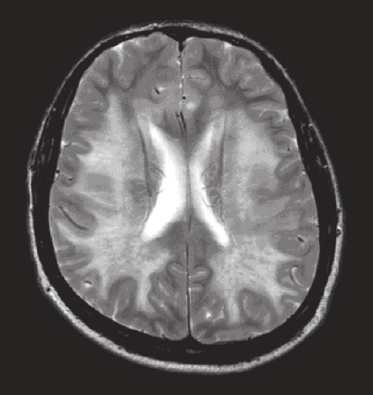 MR mozku: T2 vážený obraz
transverzálně (tři dny po vzestupu TK): abnormální difuzní zvýšení signálu bílé hmoty mozku, mozečku i mozkového kmene, patologické ložisko též oboustranně v oblasti talamu.