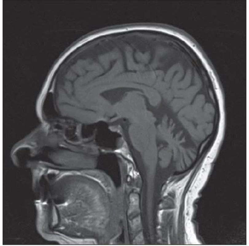 Opakovaná MR mozku s odstupem tří let se známkami progredující atrofie, zejména v oblasti vermis cerebelli.