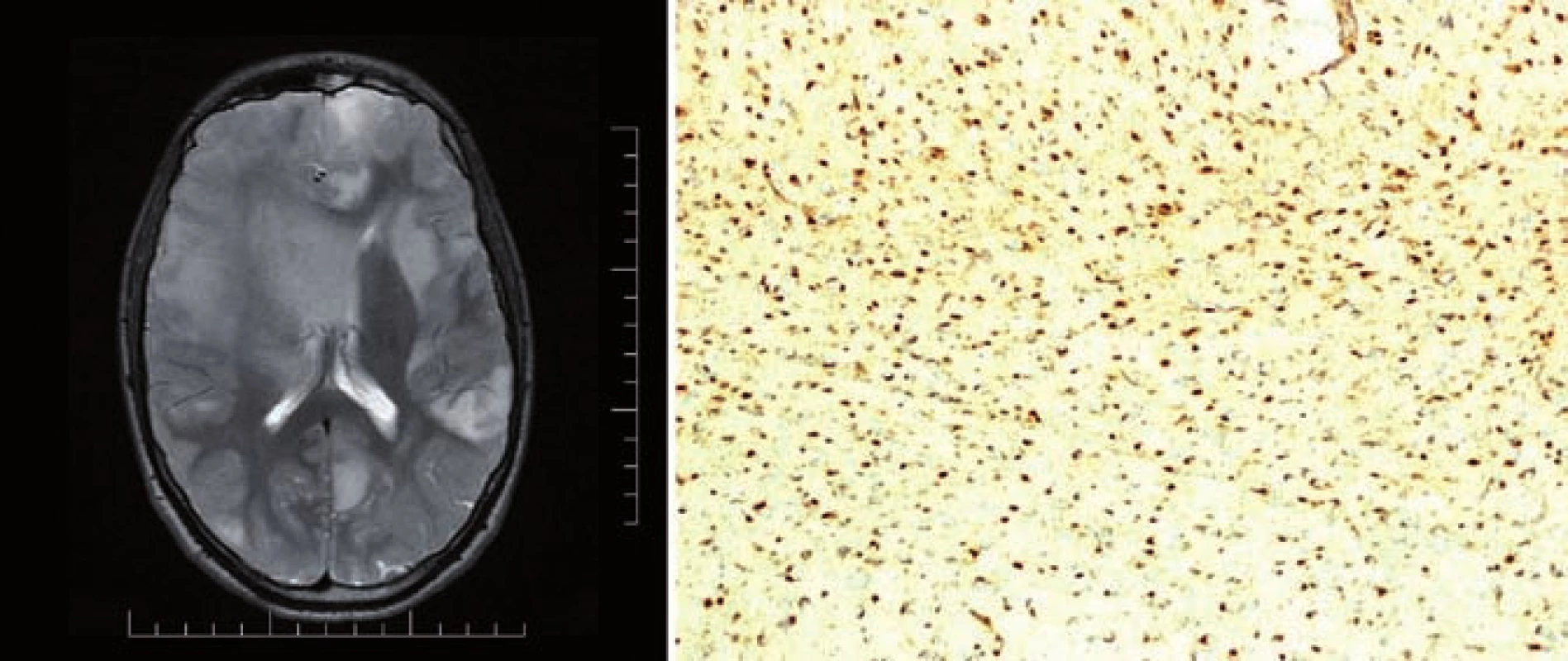 T2 vážený MR obraz pacienta s Ollierovou chorobou, nalezeny vícečetné difuzní astrocytomy mozku (A) a imunohistochemický průkaz mutace &lt;i&gt;IDH1&lt;/i&gt; R132H, 100% pozitivita (B).
Fig. 1. T2-weighted MR image of a patient with the Ollier disease, multiple diffuse astrocytomas of the brain found (A) and immunohistochemical evidence of the &lt;i&gt;IDH1&lt;/i&gt; R132H mutation, 100% positivity (B).