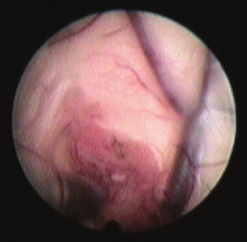 Endoskopický pohled na zakryté foramen Monroe.