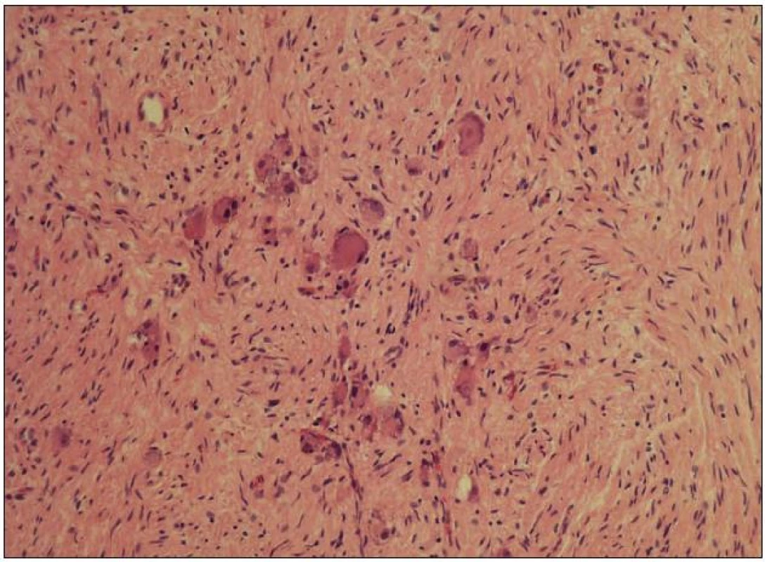 Histologický nález odpovídající zralému ganglioneuromu s převahou vřetenobuněčné stromální složky (Schwannian stroma – dominant) v barvení hematoxylin-eozin, zvětšeno 100×.
