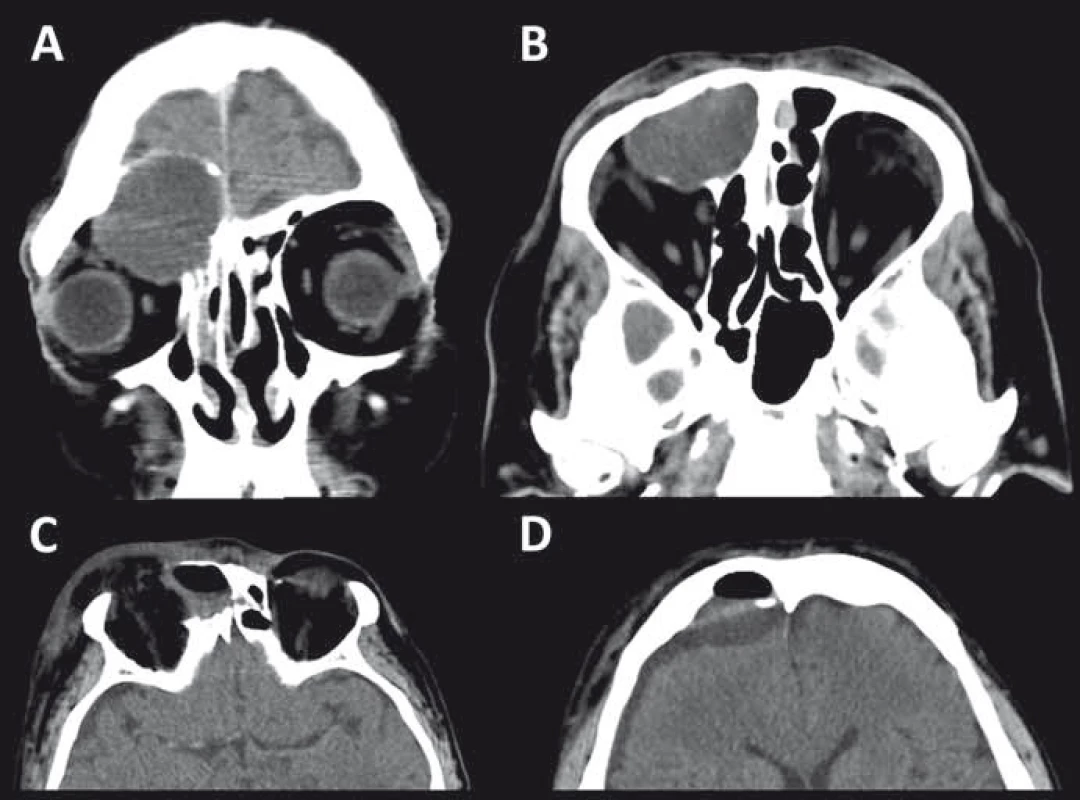 Mukokéla propagující se do pravé očnice i intrakraniálně před (A,B) a po široké endoskopické stomii do dutiny nosní (C,D) na nativním CT vyšetření.