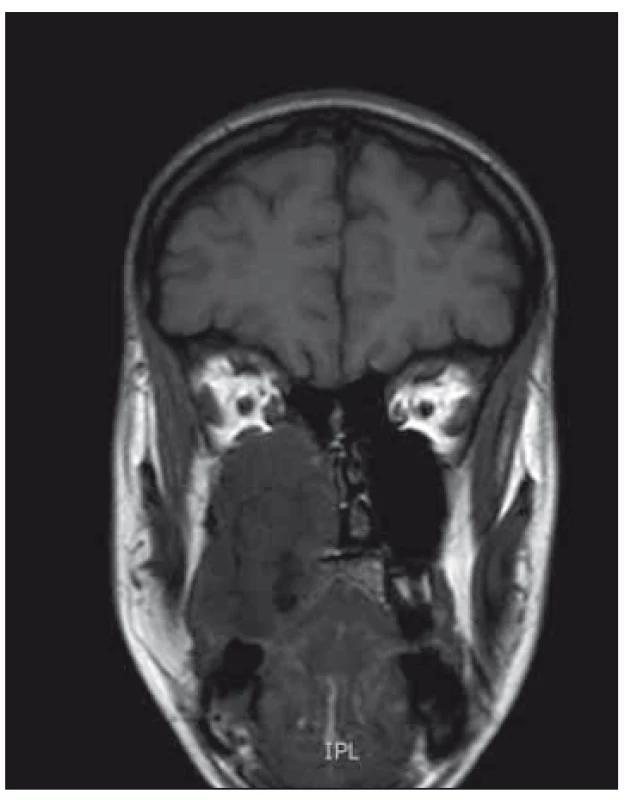 MRI coronar view – demonstrates
large mass in the maxilla extending to the
nasal cavity, also causing bulging and destruction
of hard palate.<br>
Obr. 1. MR koronární pohled – zobrazuje
masivní hmotu v horní čelisti až do nosní
dutiny, což také způsobuje deviaci a destrukci
tvrdého patra.