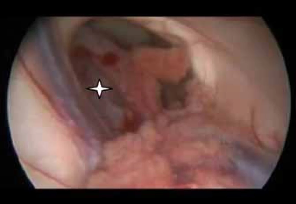Peroperační zobrazení uložení cysty (*) pomocí endoskopu.
Fig. 4. Endoscopic view of the colloid cyst (*).