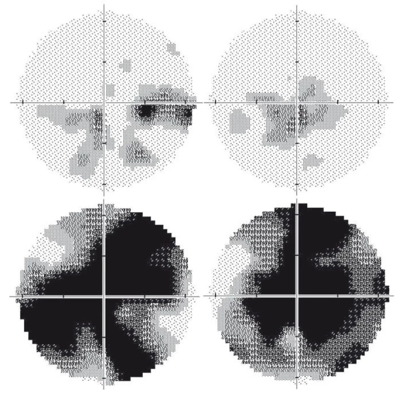 Vyšetření zorného pole u dvou pacientů s LHON na podkladě m.11778G&gt;A mutace.
Dvaatřicetiletý pacient 15 let po manifestaci: na pravém oku je několik relativních centrálních skotomů, nazálně až absolutních (A); stav odpovídá nejlepší korigované zrakové ostrosti 0,1. Na levém oku je přítomen centrocékální skotom (B); nejlepší korigovaná zraková ostrost je 0,66. Jedenatřicetiletý pacient 3 roky po manifestaci: absolutní centrální skotomy na pravém (C) i levém (D) oku, které odpovídají nízké zrakové ostrosti 0,016 na obou očích. Nálezy dokumentují širokou variabilitu výsledného postižení u pacientů se stejnou, homoplazmickou mutací v mitochondriální DNA. Zraková ostrost byla vyšetřena na Snellenových optotypech a převedena na desetinné hodnoty.
Fig. 2. Automated perimetry in two LHON patients with the m.11778G&gt;A mutation.
A 32-year-old patient 15 years after the disease manifestation: several relative to absolute central scotomas nasally in the right eye (RE); the best corrected visual acuity is 0.1 (A). Centrocaekal scotoma in the left eye (LE, B); the best corrected visual acuity is 0.66. A 31-year-old man 3 years after the disease manifestation: absolute central scotoma in the RE (C) and in the LE (D), corresponding to low visual acuity of 0.016 in both eyes. These findings document the variability in final visual impairment in patients carrying the same homoplasmic mutation in mitochondrial DNA. The visual aquity was measured using Snellen charts and converted to decimal numbers.
