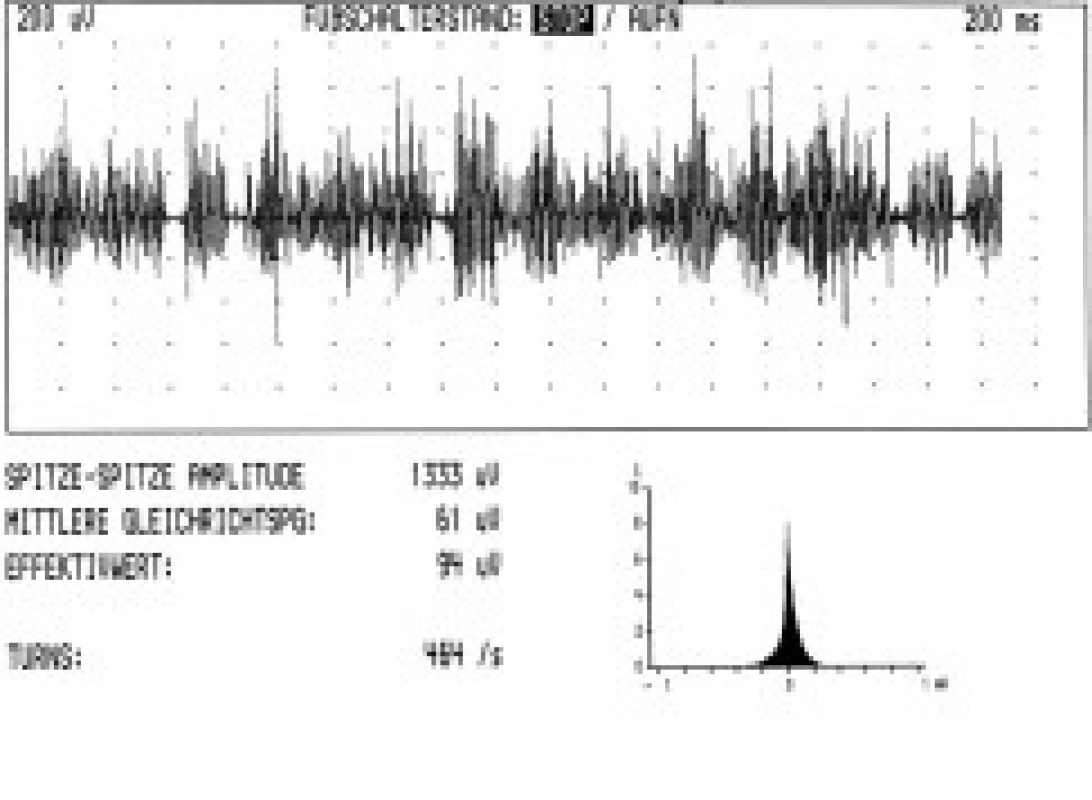 Turns/amplitude analysis u myoklonické formy cervikální dystonie v pokročilé fázi onemocnění (levostranná torticollis, záznam z m. splenius capitis vlevo, počet turns/sekunda 464) u pacienta s prokázaným dystonie – myoklonus syndromem s vazbou na chromozom 11.