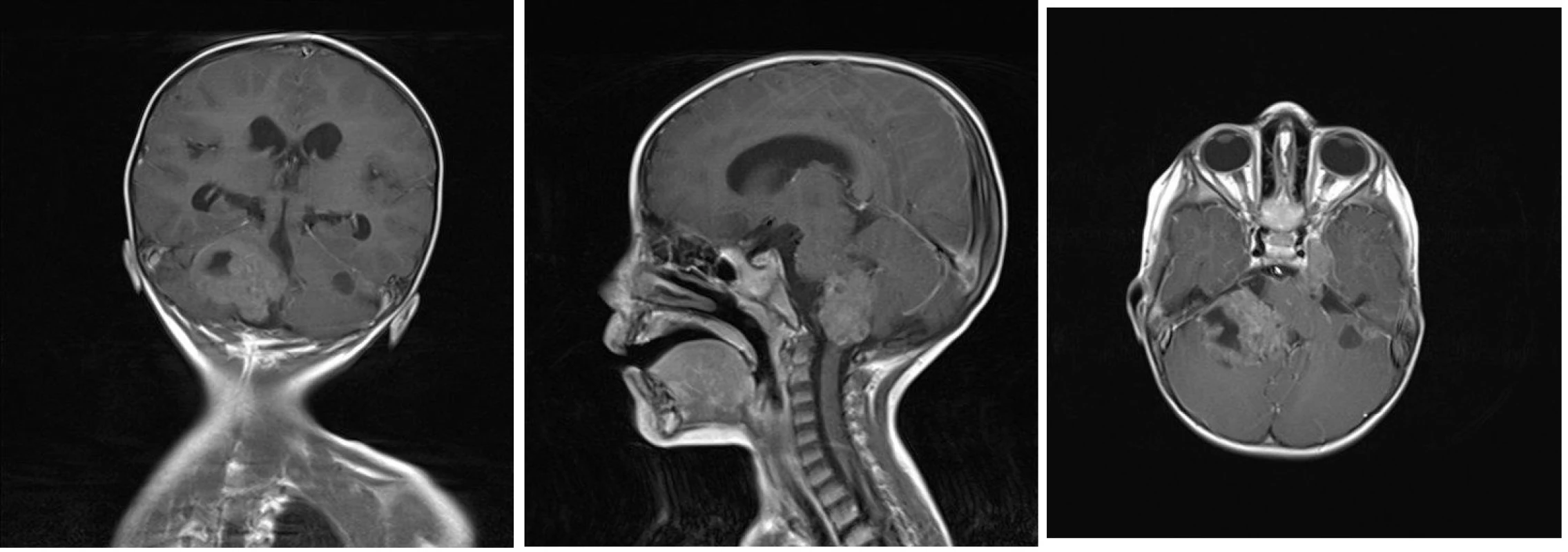 A, B, C Magnetická rezonance - koronární, sagitální a axiální T1 vážené postkontrastní obrazy ukazující  nehomogenně sytící se ložisko v zadní jámě lební vpravo, které zasahuje do foramen magnum, infiltruje pravou cerebelární hemisféru a mozkový kmen. Dále jsou na axiálním zobrazení patrné menší útvary - metastázy podobného vzhledu v zadní jámě lební vlevo, v oblasti Gasserského ganglia vlevo a v pravém hippokampu.
Image 3 A, B, C: Magnetic resonance – coronary, sagittal and axial T1-weighted images showing heterogenously enhancing tumor of posterior skull fossa reaching foramen magnum and infiltrating right cerebellar hemisphere and brain stem. Furthermore, other foci of metastasis in left posterior skull fossa, in ganglion Gasseri region and in right hippocampus are visible.