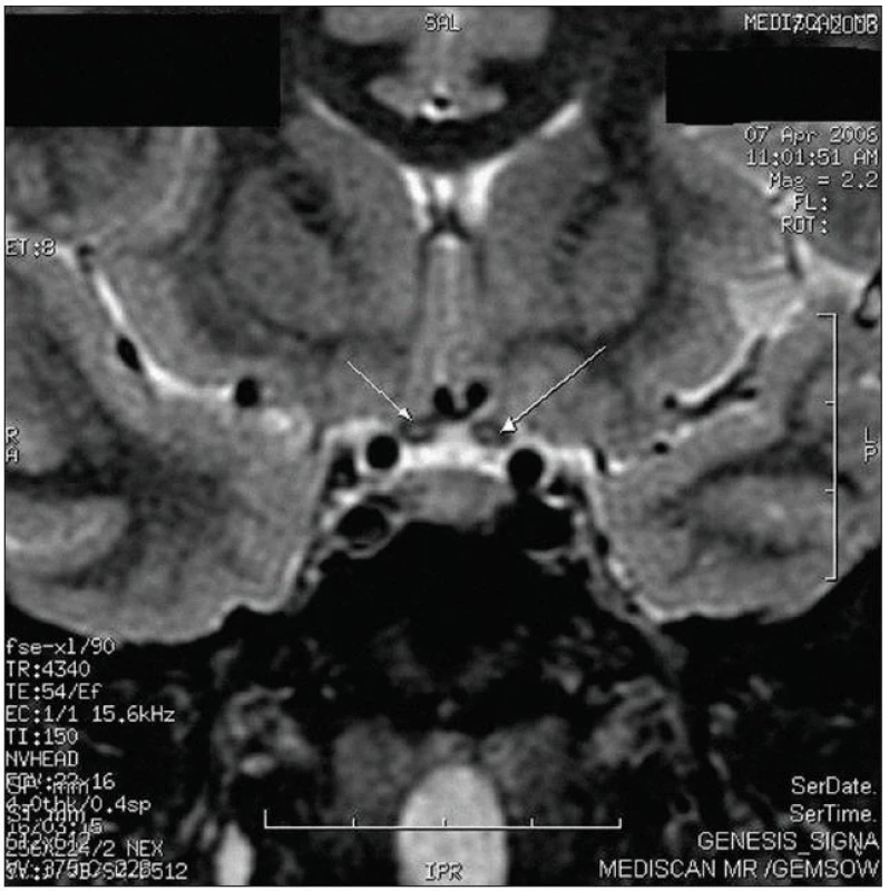Magnetická rezonance mozku s diskrétními tečkovitými hypersignálními ložisky v optických nervech a chiazmatu na koronárním řezu na sekvencích FSTIR.
Obrázek laskavě poskytla MUDr. Helena Štěňhová z Diagnostického centra Mediscan, Oddělení MR DC Mediscan.
