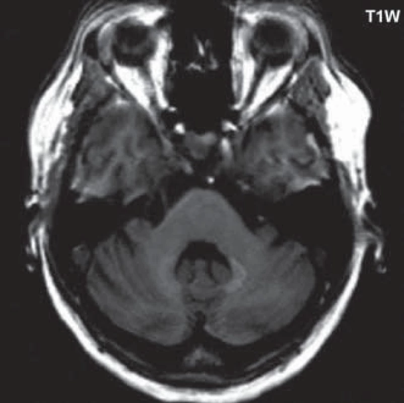 T1 vážený obraz, v oblasti nucleus dentatus bilaterálně je patrná zvýšená intenzita signálu.
Fig. 1. T1-weighted image, in the dentate nucleus bilaterally, there is increased signal intensity.