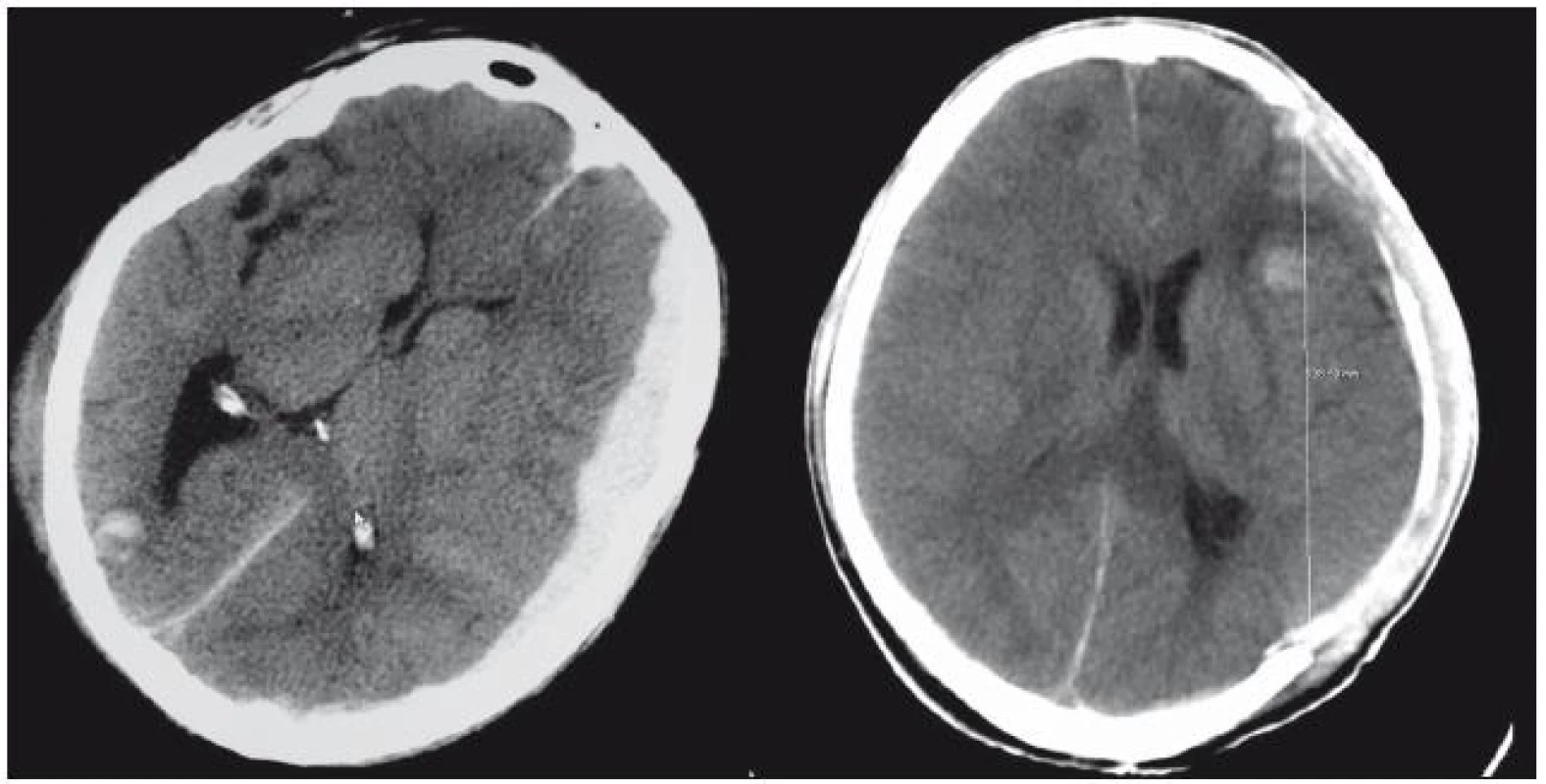 Pacient s ASH před a po provedení hemisferální DK.
