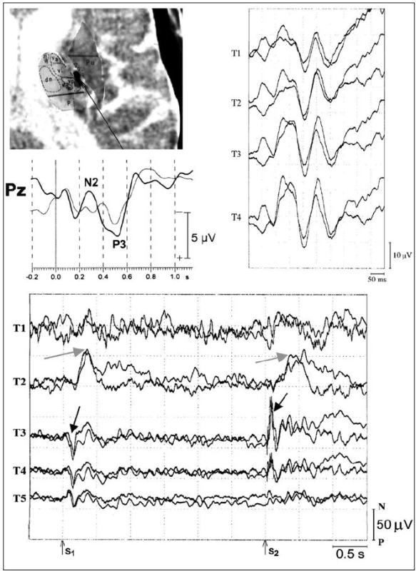 Vlna P3 komponenty středně- a dlouholatenčních evokovaných potenciálů.
Horní část: Ukázka uložení intracerebrální elektrody T v pravém thalamu – superpozice intracerebrální elektrody na CT, ukázka intracerebrální registrace sluchové vlny P3 a dalších komponent v odd-ball paradigmatu snímané z pravého zadního thalamu (vpravo).
Střední část: Ukázka vlny P3, skalpová registrace z elektrody Pz (zapůjčeno z archivu prof. MUDr. Milana Brázdila, Ph.D.).
Dolní část: Ukázka středně a dlouholatenčních komponent vlny P3, registrováno v paradigmatu
CNV. Výrazná změna amplitudy svědčící pro přítomnost generátorů (šedá a černá šipka); snímáno z intracerebrální elektrody T, čísla označují jednotlivé kontakty intracerebrální elektrody (T1–5).
S1: varovný, warning, podnět; S2:vykonávající, imperativní podnět. Upraveno dle [3,4,48,52].