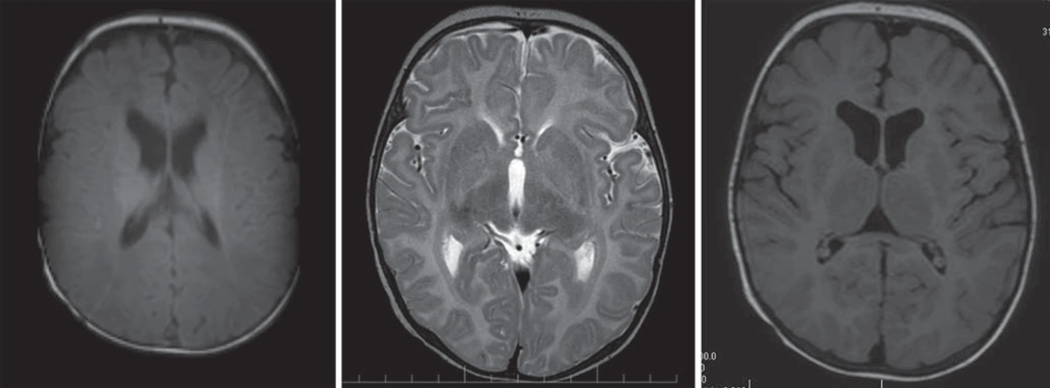 Pelizaeus-Merzbacherova choroba, 8-mesačný chlapec.
Obr. 5a) T1WI – znížená intenzita signálu postihnutých oblastí charakteru hypomyelinizácie.
Obr. 5b, c) T2WI (b) a FLAIR (c) s difúznou zmenou zvýšeného signálu charakteru hypomyelinizácie.